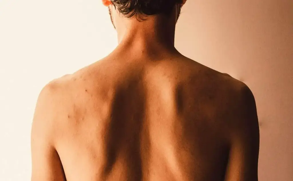 Back acne is a common problem, especially for men.