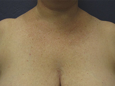 Shoulder dips from bra Clearance