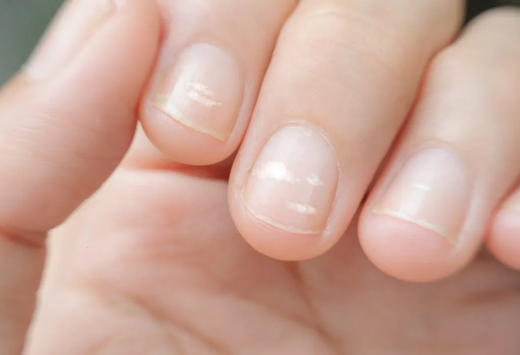 Find out what causes white spots on nails vitamin deficiency — Eating  Enlightenment