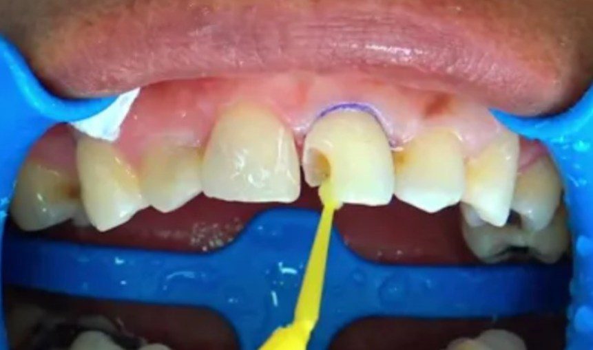 Caries dental en un incisivo superior