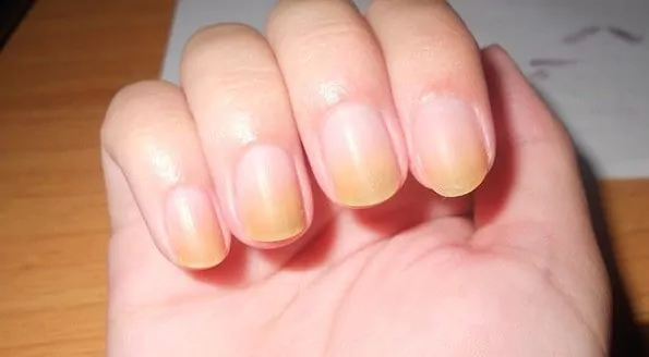 6 Ways to Stop Biting Your Nails - wikiHow