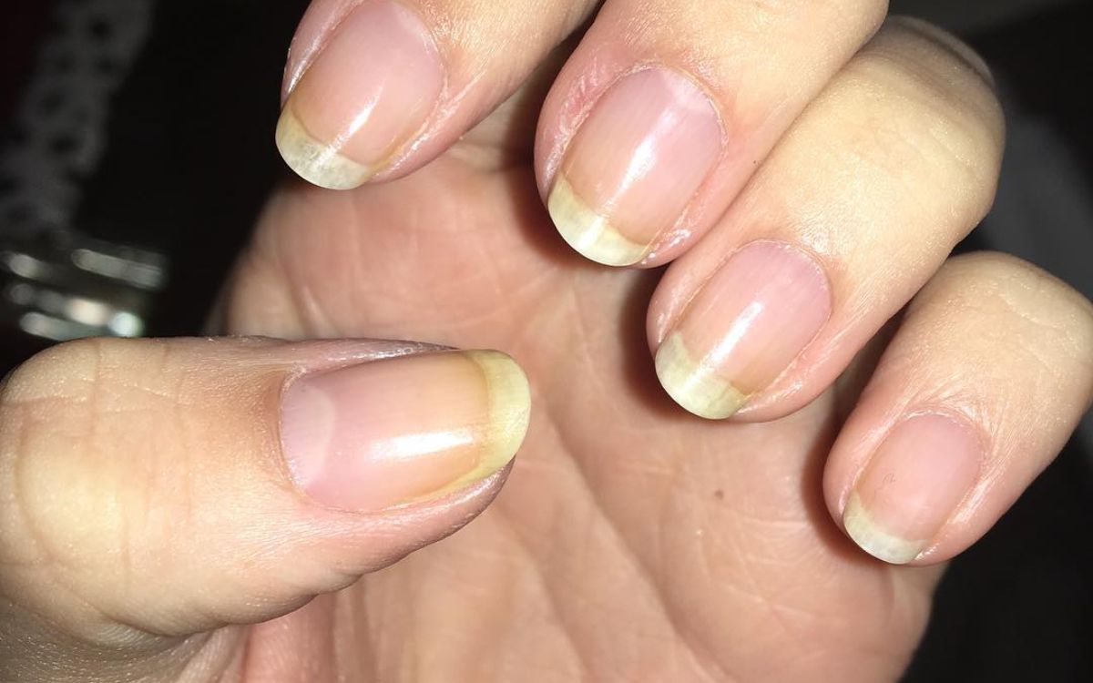 What Is The Cause Of Yellow Nail Syndrome